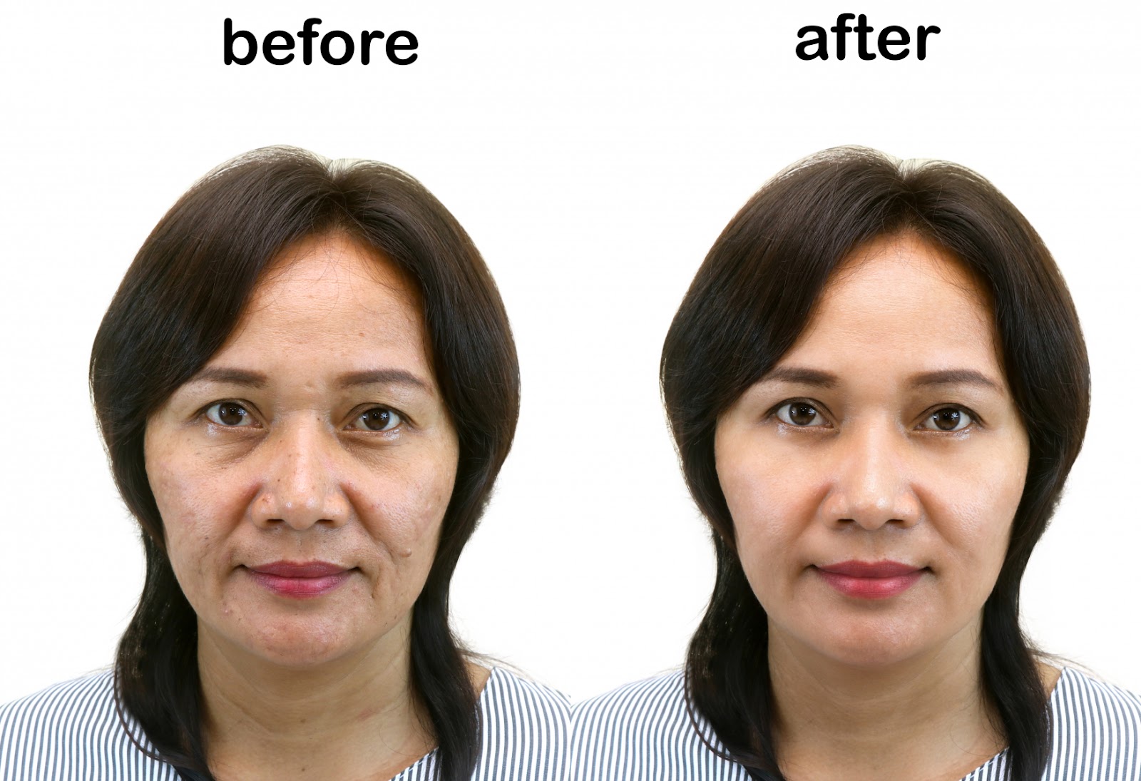 Căng da mặt bằng chỉ collagen - Đánh bay các nếp nhăn phần đuôi mắt, trán, rãnh mũi má, và toàn bộ khuôn mặt.