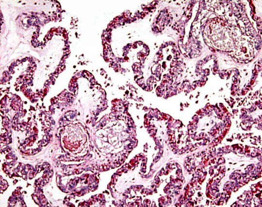 Villous tissue with large 'inclusion'.