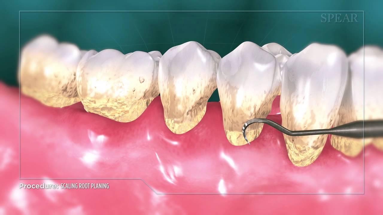 dental implants clinic in Delhi