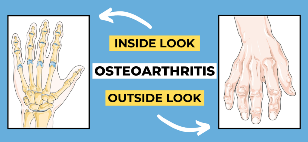 skeletal fluorosis osteoarthritis effect, inside and outside look