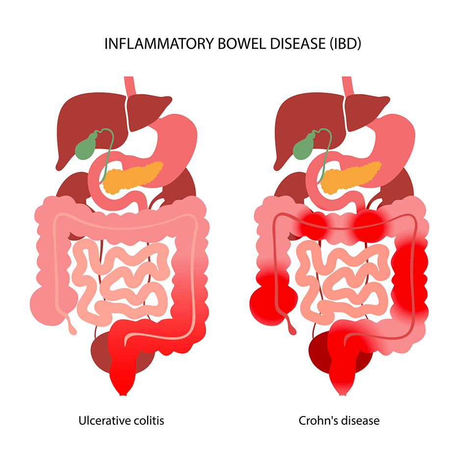 Inflammatory Bowel Disease (IBD) | Johns Hopkins Medicine