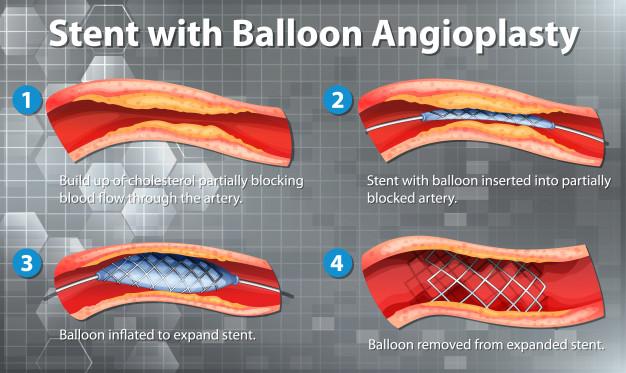 Stent with balloon angioplasty