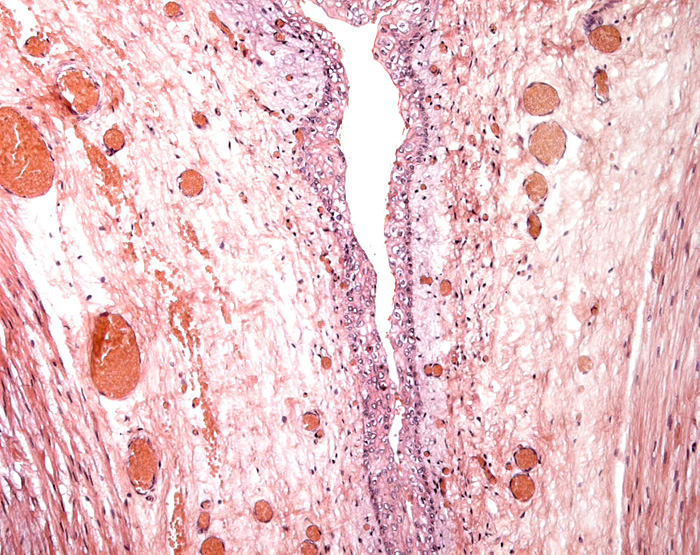 allantoic duct in the umbilical cord