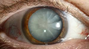 Cataract Awareness Month
