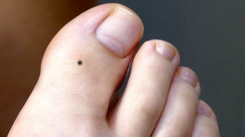 nốt ruồi ở ngón chân cái