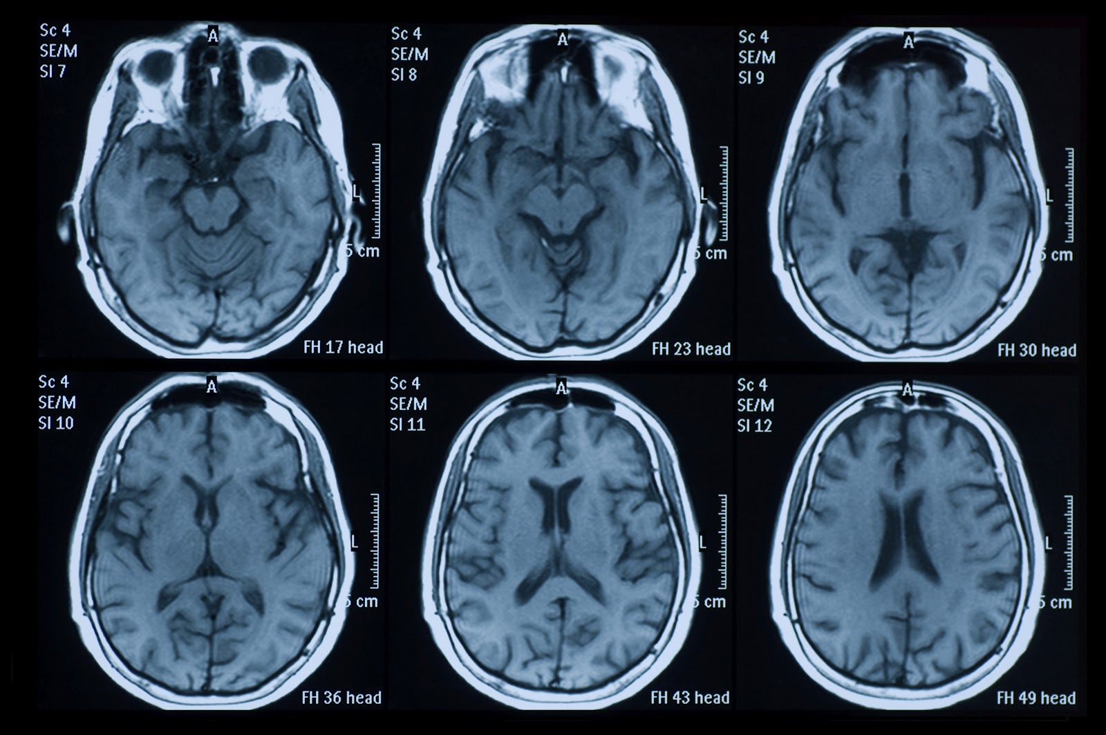 MRI Scans Detect Parkinson's Disease in it's Earliest Stages, Study Finds |  Time