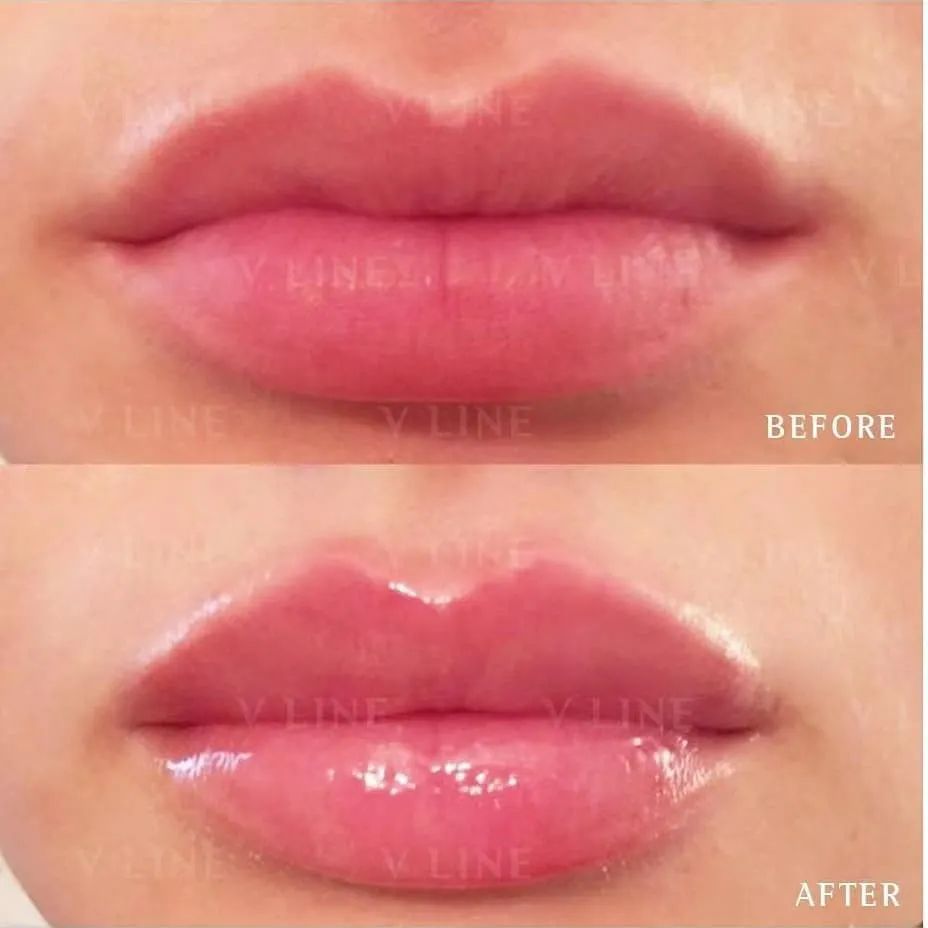 Before and After Transformation of Dermal Fillers Used To Add Definition and Plumpness to The Lips