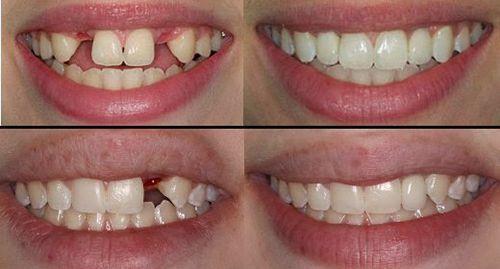 Image result for trồng răng sứ mất thời gian bao lâu