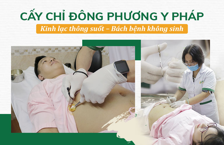 Cấy chỉ Đông phương Y pháp ngày càng phát triển