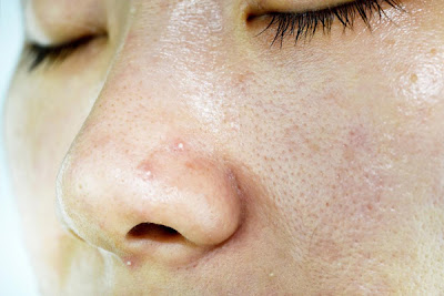 Liệu trình chăm sóc da mặt chuyên sâu đối với da dầu