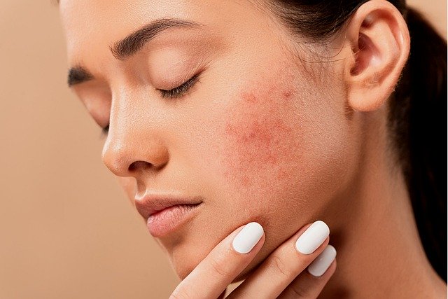 Descubre las mejores plantas medicinales para el acné