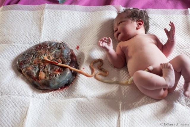 No Es Sangre Del Cordon Es Sangre Del Bebe Plataforma Cientifica En Defensa Del Pinzamiento Optimo Del Cordon Umbilical