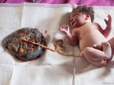 √ 99 ou plus sangrado cordon umbilical bebe 236578-Sangrado cordon umbilical bebe