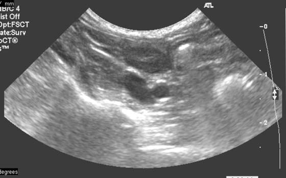 Sonogram of the same unilateral cryptorchid one year old Yorkshire Terrier with an intra-abdominal testis, here shown in oblique section scan plane in the top center of the image