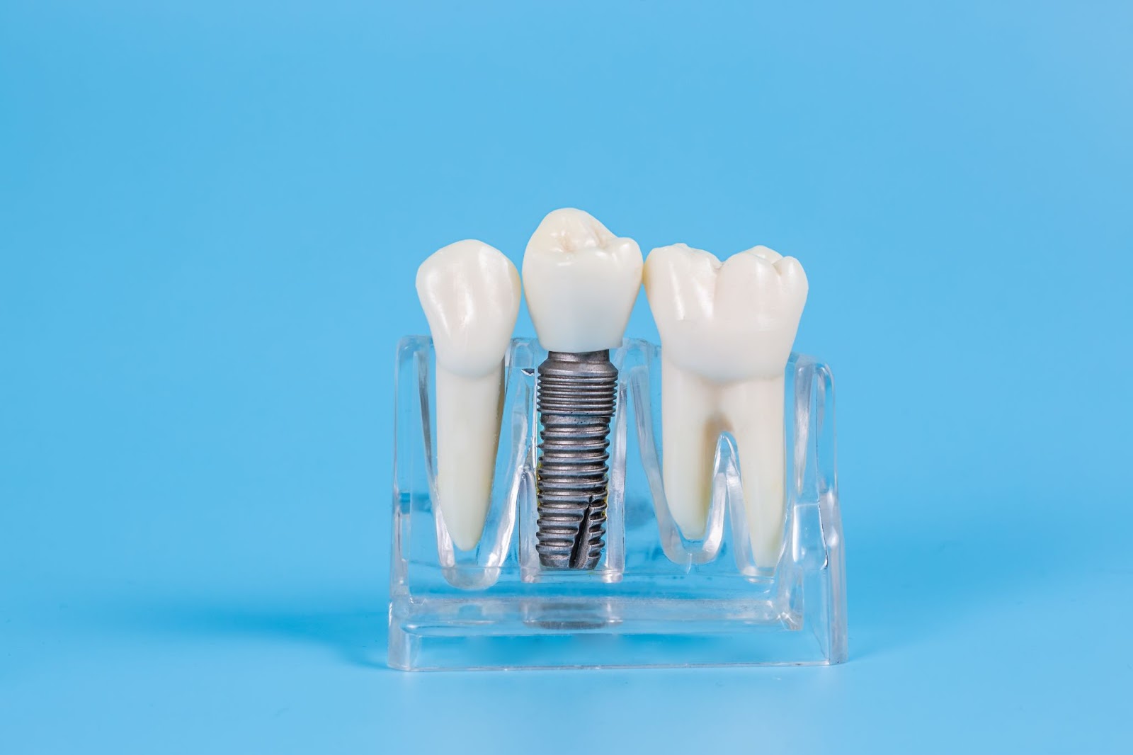 Implantes dentales que sustituyen una arcada completa de dientes perdidos