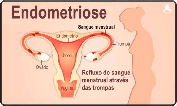 Resultado de imagem para medicamentos para endometriose