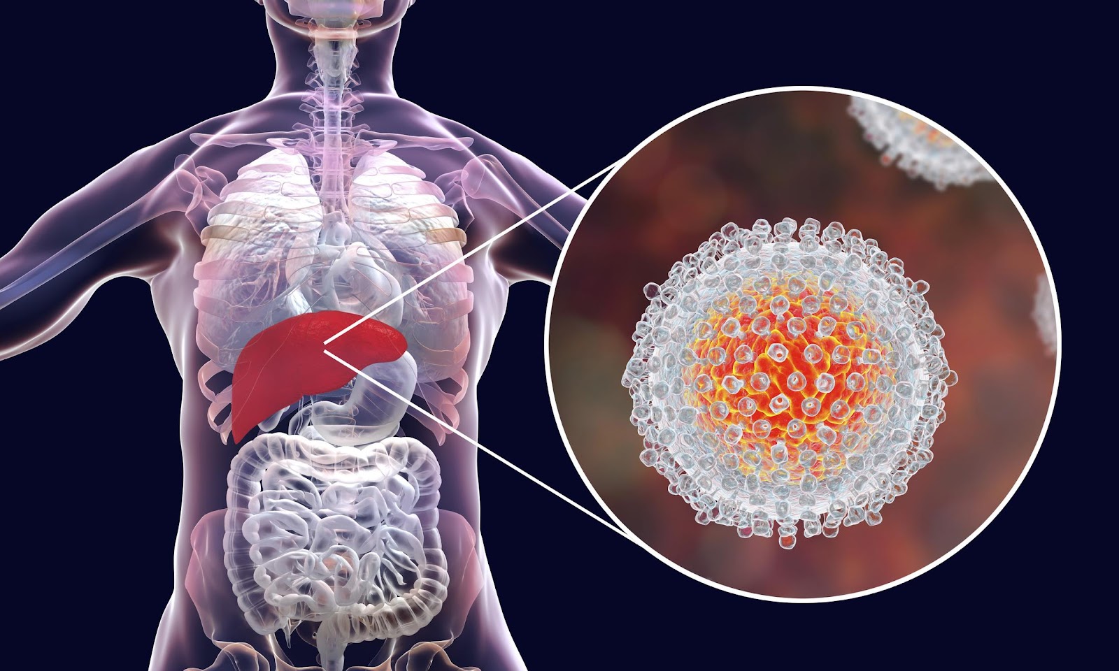 Hepatitis C- How does it occur and ways to manage it? - Yashoda Hospital