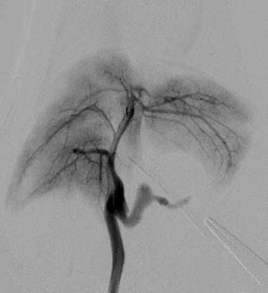 Digital subtraction angiogram of cat with congenital extrahepatic PSS after ligation