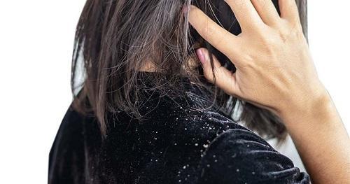 dandruff.jpg