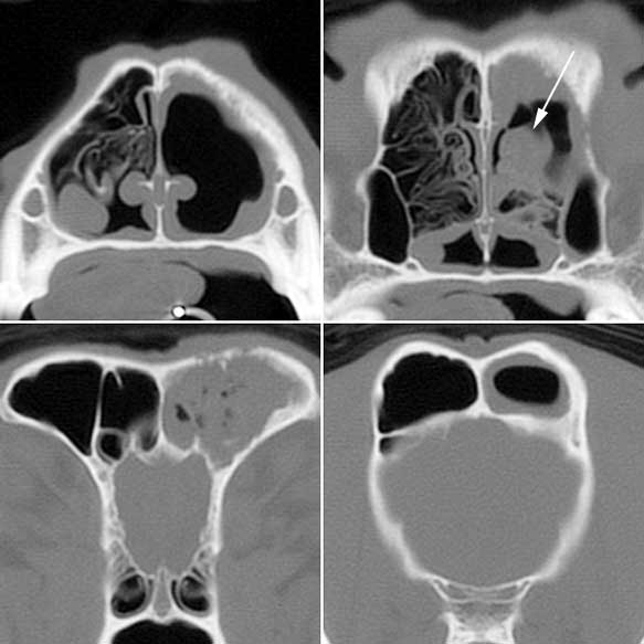 CT scans of a 10-year-old, neutered male, Border collie depicting a destructive sinorhinopathy without mass effect due to aspergillosis.