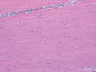 Photomicrograph of normal suspensory ligament. The microscopic structure of the suspensory ligament is similar to tendon. A linear arrangement of ligament fibers has desmocytes aligned on the fibers. Fascicles made up of fibers are separated by connective tissue that holds vessels and nerves. 
