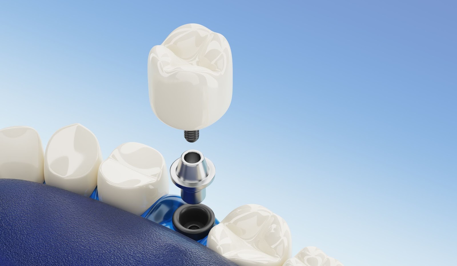 Impianti dentali che sostituiscono un'intera arcata di denti mancanti