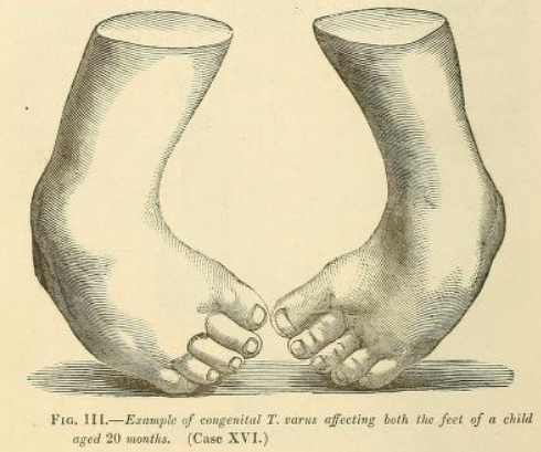 Source: W.J. Little, A Treatise on the Nature of Club-Foot and Analogous Distortions; including Their Treatment Both With and Without Surgical Operation. London, W. Jeff’s, 1839, p. 4. 
