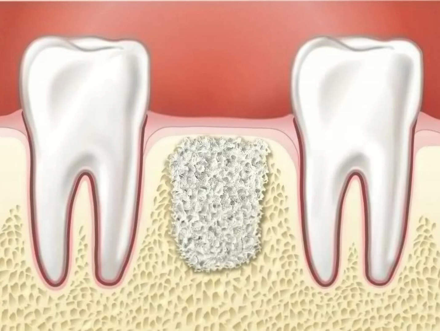teeth implant in Vancouver 