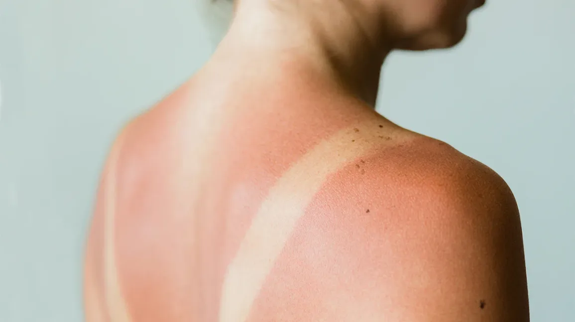 Paste for Sun Burns 