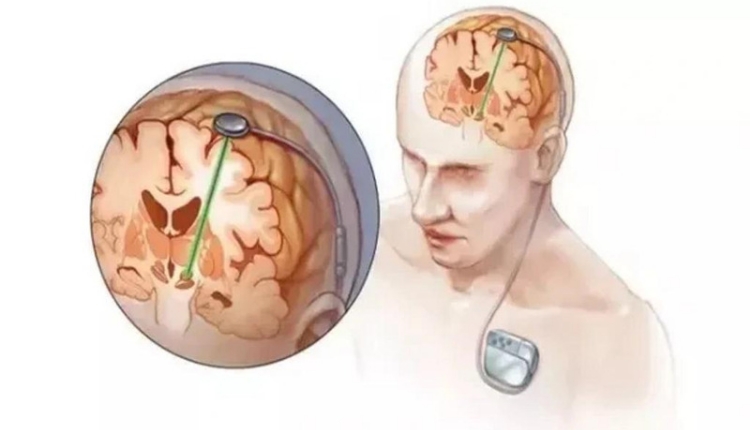 إجراءات جراحة استئصال الفص الصدغي