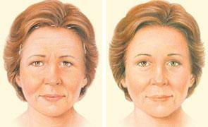 F:\aura\webpage\COSMETIC SURGERIES\brow lift\brow-lift-endoscopic-incision.jpg