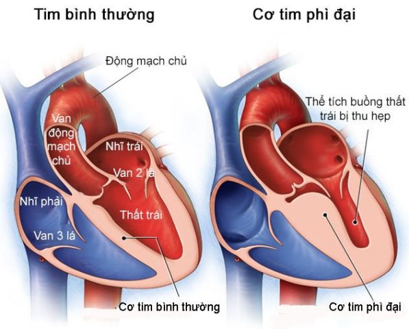 co-tim-binh-thuong-va-co-tim-khi-bi-phi-dai