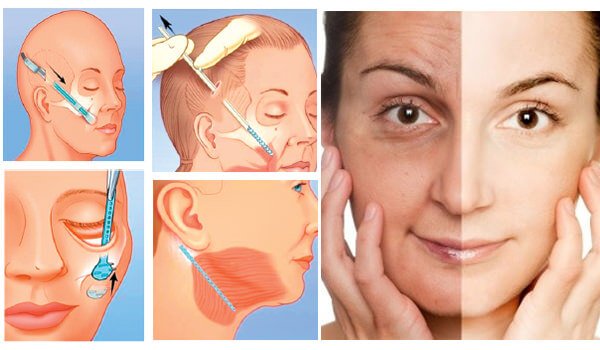 6 cách làm căng da mặt vô cùng hiệu quả - Phẫu thuật căng da mặt