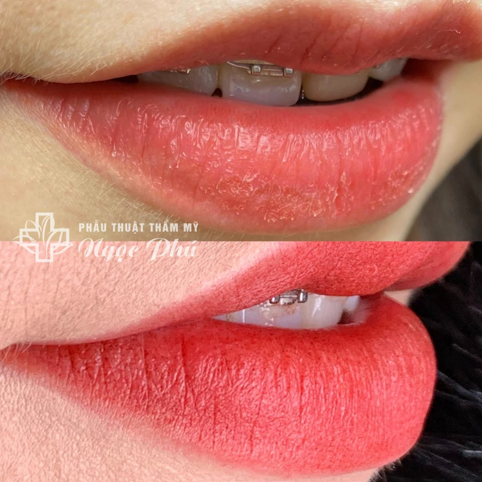 không chỉ phun xăm môi mà các dịch vụ khác tại Thẩm Mỹ Việt Nam, chị em còn có thể được nhận ưu đãi với mức chi phí vô cùng phải chăng.