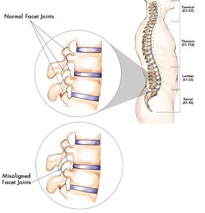 facet-joint-syndrome-back-pain.jpg