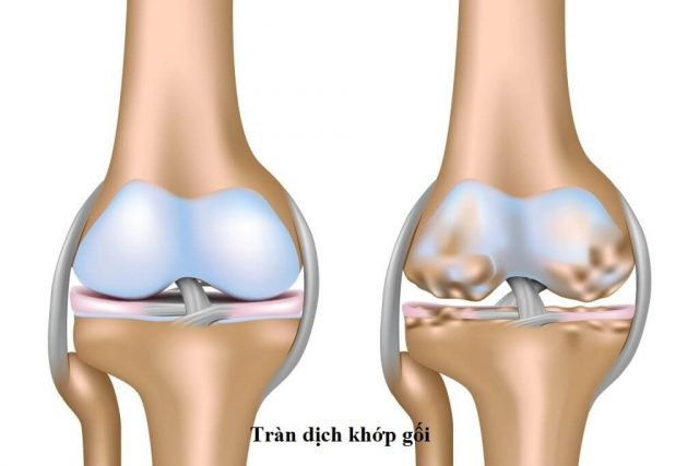 tràn dịch khớp gối có nên xoa bóp không