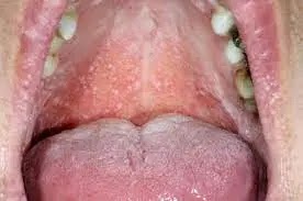 What Is Oral lichen planus