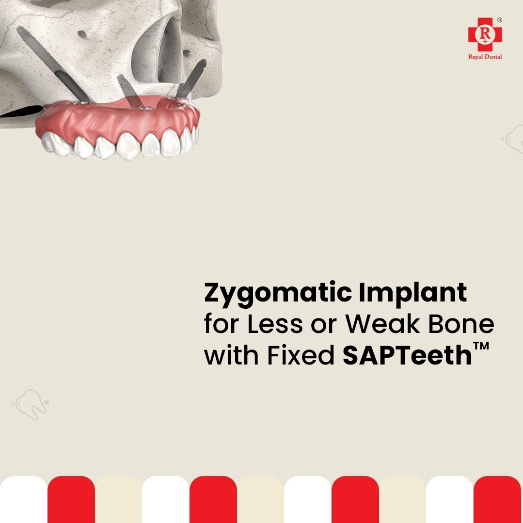 Zygomatic Implant with SAPTeeth at Royal Dental Clinics