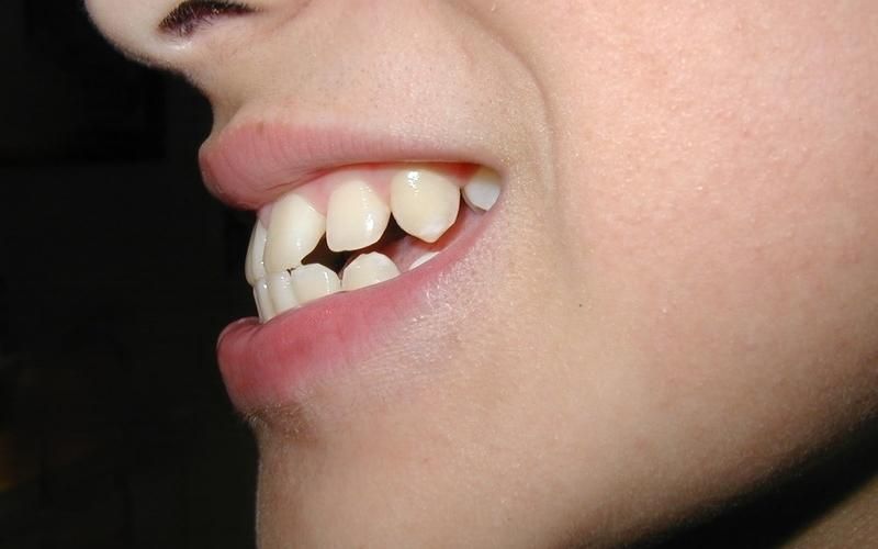 Răng quặp vào trong ảnh hưởng đến chức năng ăn nhai