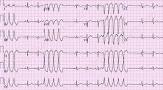 Image result for arrhythmia ecg examples
