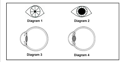The diagram above shows the human eye under different conditions
