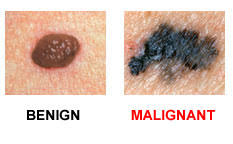 Image result for melanoma