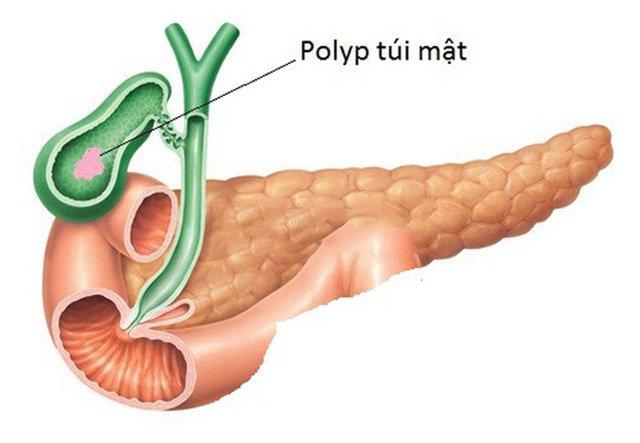 Polyp túi mật là bệnh gì và có cần phải điều trị không? | Vinmec