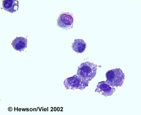Alveolar macrophages from BAL. Wright-Giemsa stain. Magnification: 1000X.