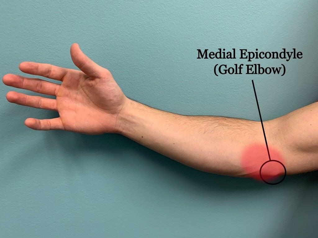 Tennis Elbow versus Golf Elbow - Capital Chiropractic