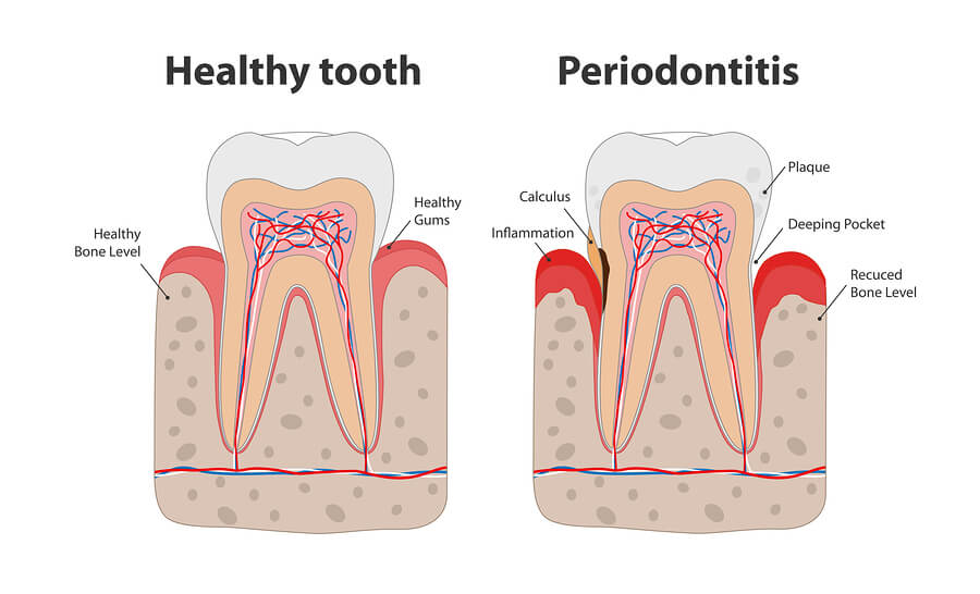 Fastest Way To Get Antibiotics For Tooth Infection PlushCare