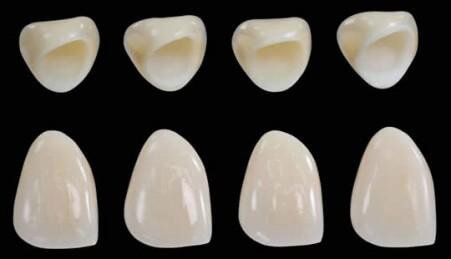 răng toàn sứ cercon