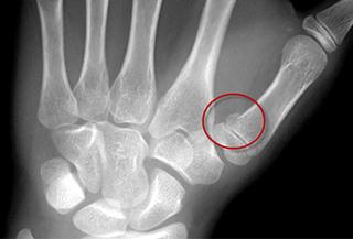 Bennett's Fracture - Hand Therapy