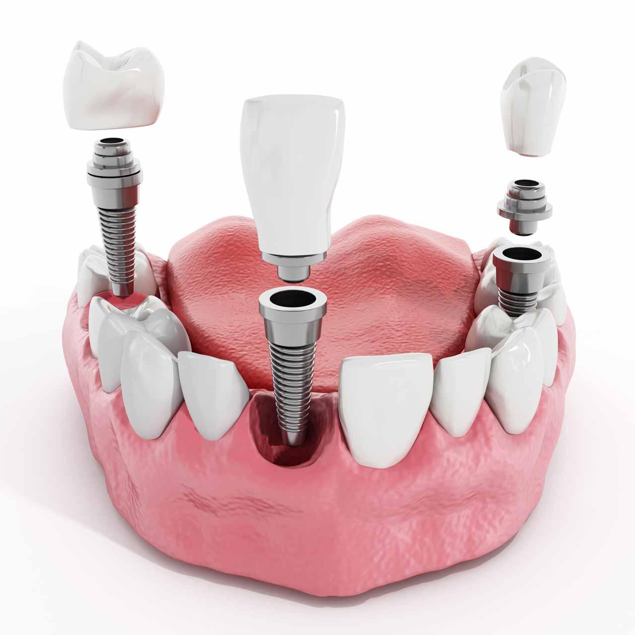 dental implant center 