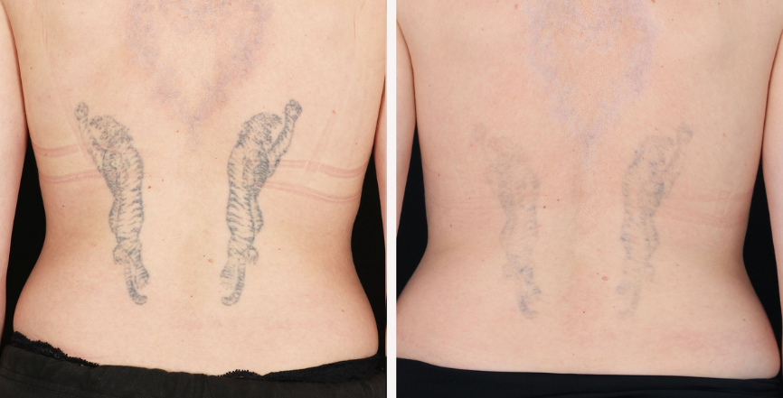 Tattoo Removal: Understanding The PicoWay Laser - Blush Beverly Hills